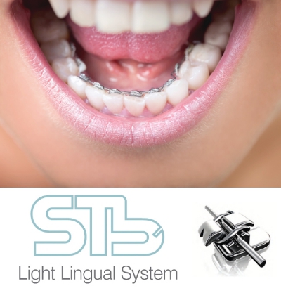 Лечение на лингвальной брекет-системе STb